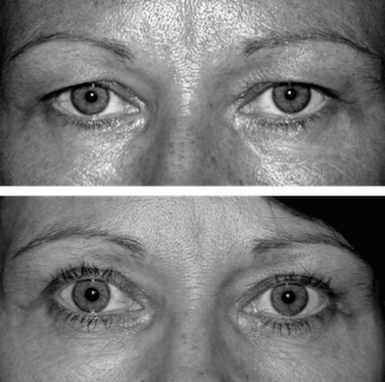 Upper eyelid blepharoplasty