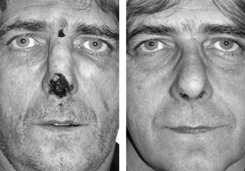 Nose reconstruction